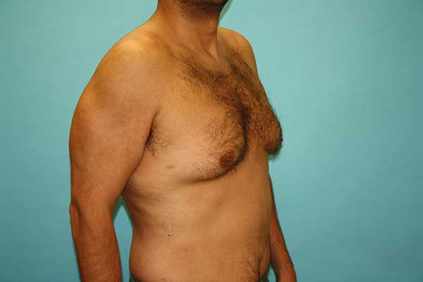 Gynecomastia Treatment NYC | Long Island | Male Breast Reduction NYC
