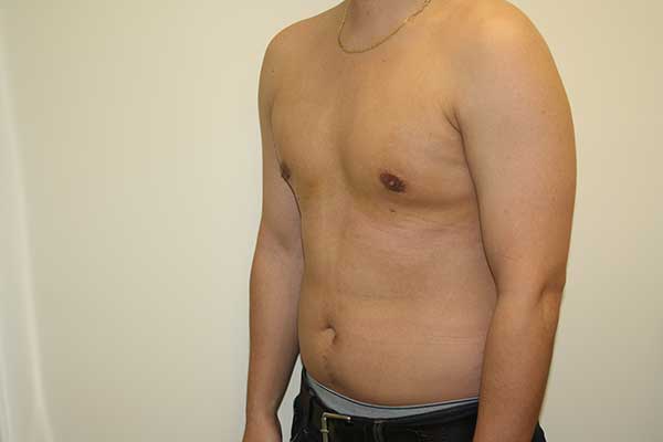 Male Breast Reduction Long Island | NYC | Gynecomastia Surgery Long Island
