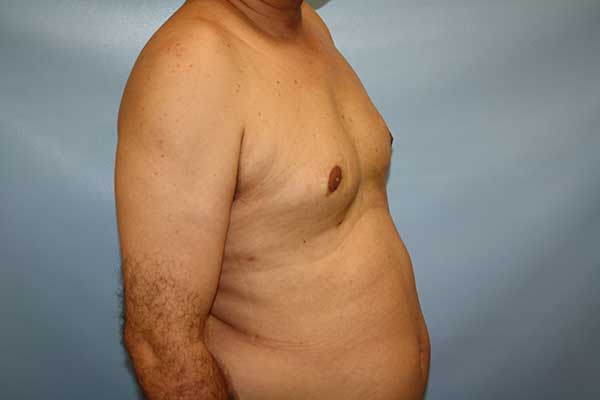 Male Breast Reduction Long Island | Long Island | Gynecomastia Surgery Long Island