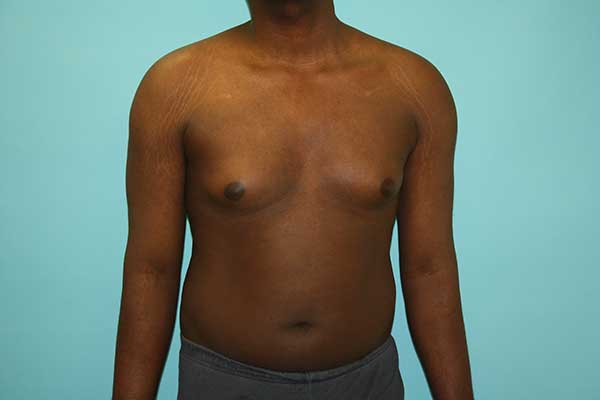 Male Breast Reduction NYC | Long Island | Gynecomastia Surgery Long Island