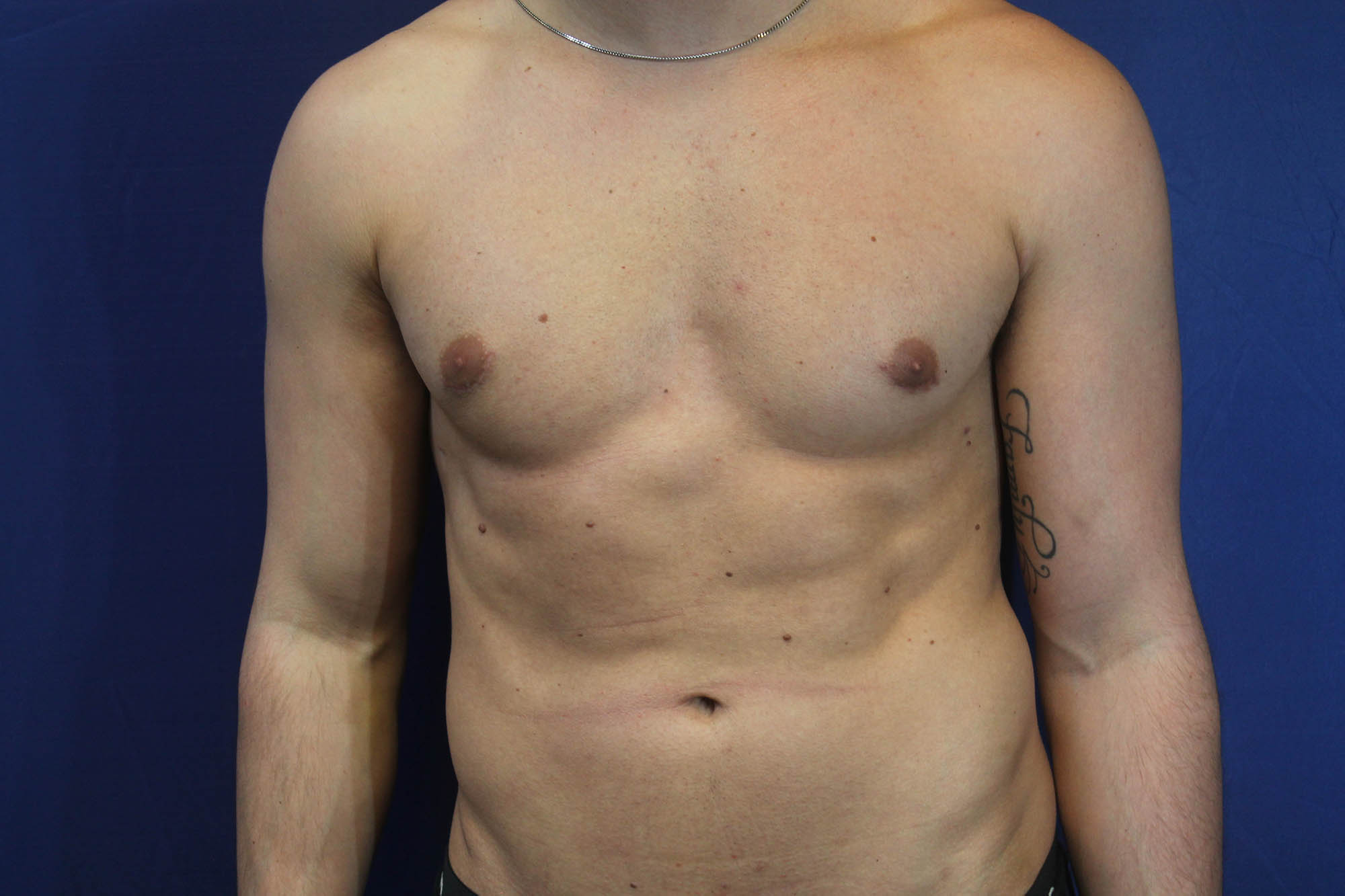 Gynecomastia Surgery Long Island | NYC | Male Breast Reduction NYC