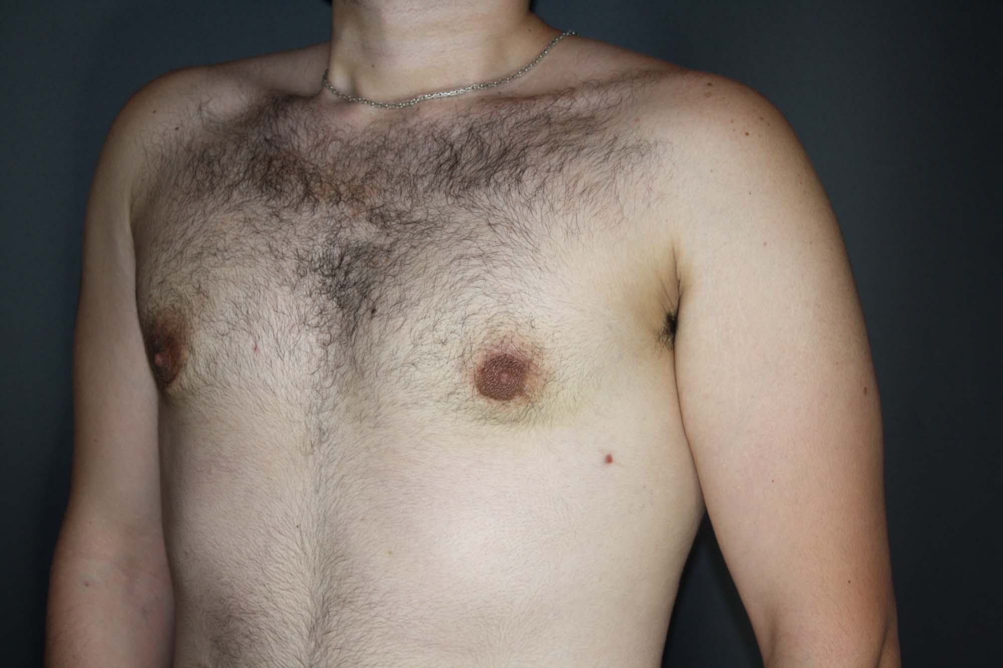 Gynecomastia Surgery Long Island | NYC | Male Breast Reduction NYC