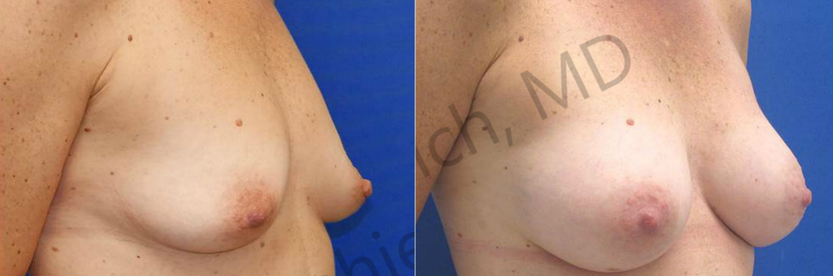 Breast Augmentation NYC | Laser Liposuction Long Island | NYC