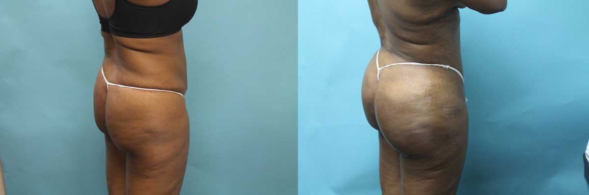Butt Lift Surgery NYC | Long Island | Brazilian Butt Lift NYC