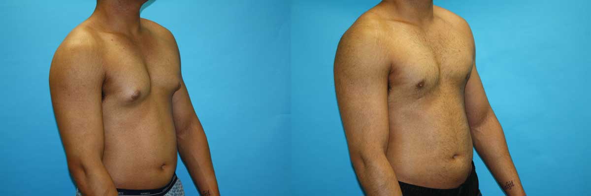 Male Breast Reduction NYC | Long Island | Gynecomastia Treatment NYC